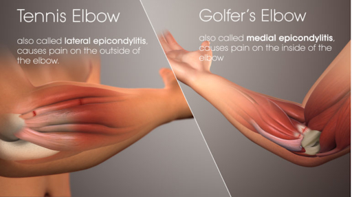 tennis elbow vs golfer elbow